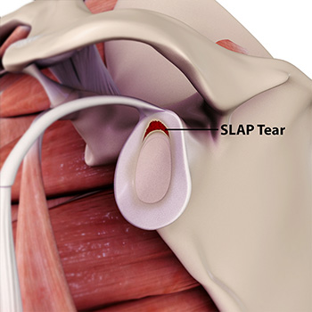 slap tear